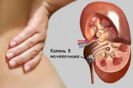 Оксалат в урината като Оксалат в урината като