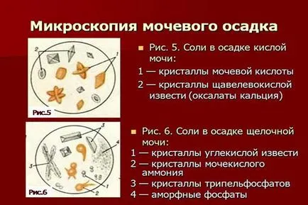 Оксалат в урината като Оксалат в урината като