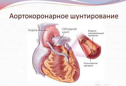 Операция след сърдечен удар
