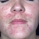 Каква е подуване на лицето