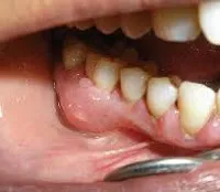 Какво е абсцес на венците Какво е абсцес на венците