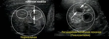 Pyelectasia го плодове