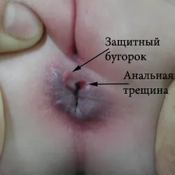 анален лечение фисура при деца