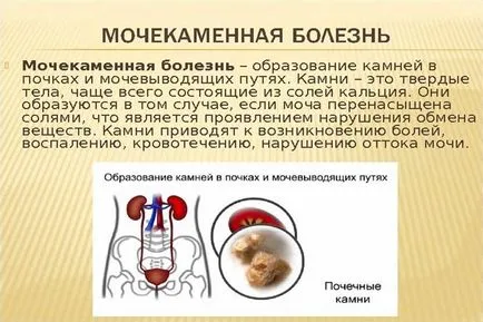 Средства за лечение на камъни в бъбреците Средства за лечение на камъни в бъбреците