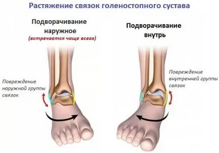 За лечение на сухожилие разкъсвания