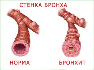 Как бронхит