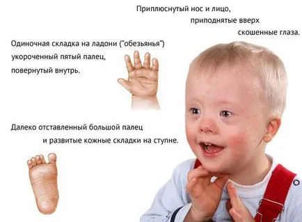 Синдром на Даун Лечение