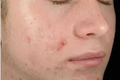 Ретиноиди какво е