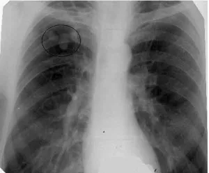 Какво е белодробна tuberculoma
