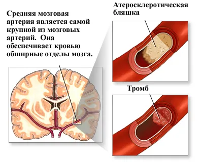 Какво е кръвен съсирек в главата му