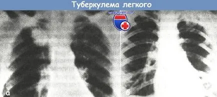 Какво е белодробна tuberculoma