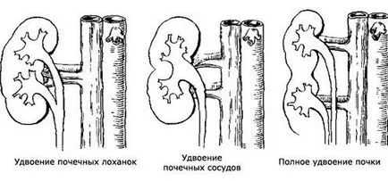 Какво е частично удвояване на бъбреците