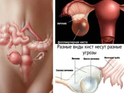 Блокада на матката и придатъците