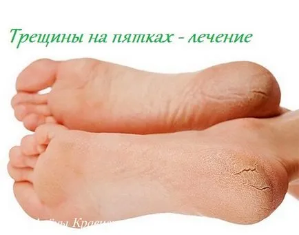 Как да се отървем от пукнатини по петите бързо и ефективно, блог Алена Кравченко