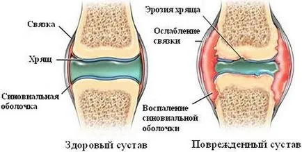 Лечение на стави на ръцете народни средства