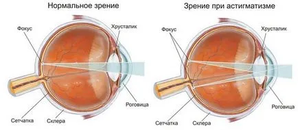 Астигматизмът при децата - причини, симптоми и лечение
