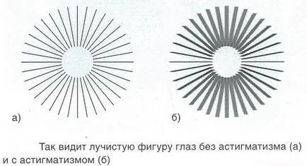 Астигматизмът при децата - причини, симптоми и лечение