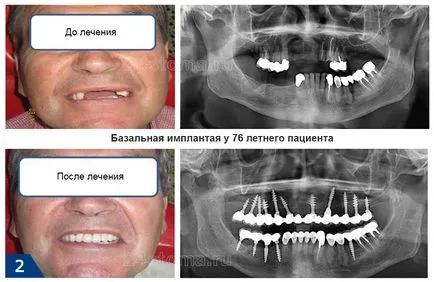 Базовите импланти - Мнения на плюсовете и минусите, цената за 2017