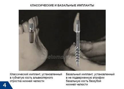 Базовите импланти - Мнения на плюсовете и минусите, цената за 2017