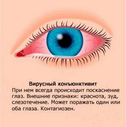 Изплакването или изтриване на окото с конюнктивит при деца (деца) Изплакването или избършете окото с конюнктивит при деца