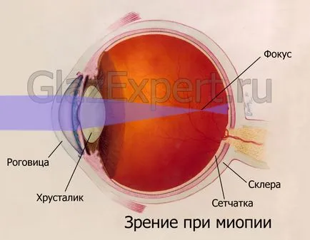 Какви са причините за късогледство очни симптоми и лечение на различни степени