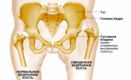 Хип дисплазия при децата симптоми, диагностика и лечение