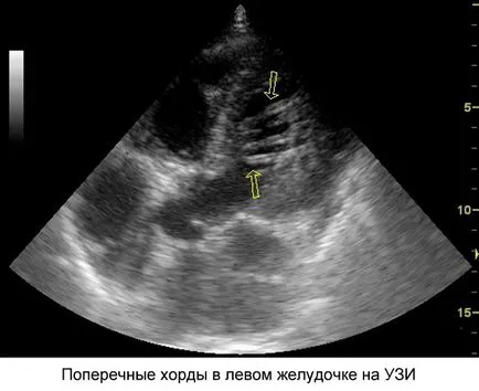 Допълнителна акорд на лявата камера води, видове, симптоми и лечение