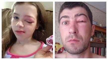 Ако ухапан от комар в очите на възрастния или детето какво да правя