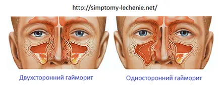Синузит симптоми, лечение, хората, антибиотици