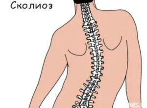 Как да определите сколиоза дома диагностика методи отклонение (сколиоза) Как да се определи Сколиозата дома диагностични методи отклонения