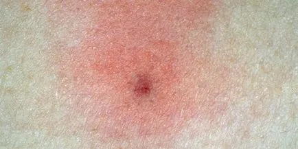 Как и какво лечение на раната след ухапване от кърлеж