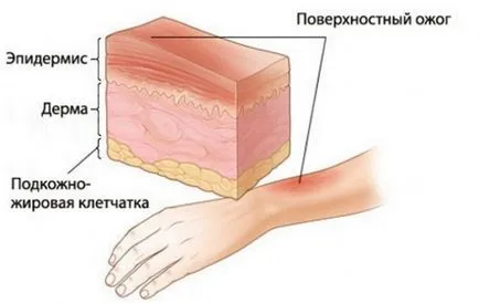 Докато лекува изгаряния 1, 2, 3, 4 градуса
