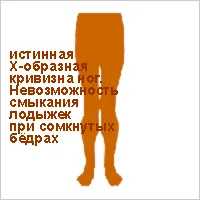 Как да се определи криви краката упражнения, здраве рецепта