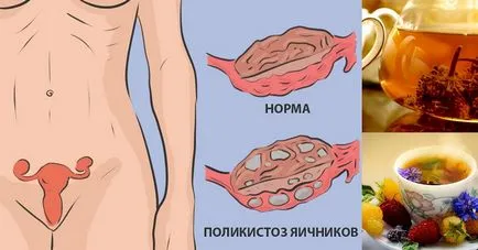 Как за лечение на синдром на поликистозните яйчници