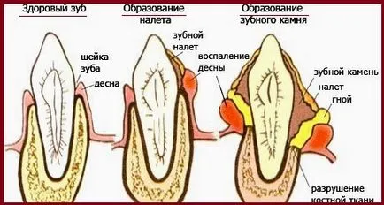 Как да се отървем от зъбен камък у дома