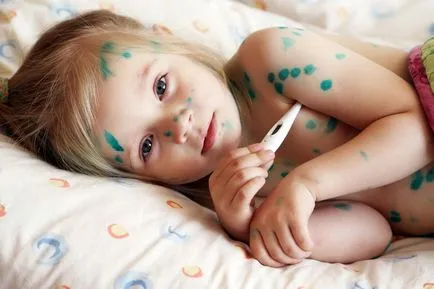 Как за лечение на варицела при деца ние се отървете от обрив и сърбеж (обработен) Как за лечение на варицела при деца ние се отървете от обрив и сърбеж