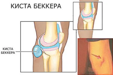 киста Bekker зад симптомите на коляното, как да се отнасяме