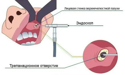 Киста в носа (назални синуси) симптоми, лечение, последици