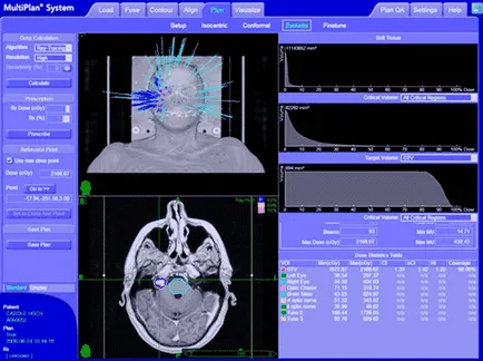 Cyber ​​нож (cyberknife), лечение на рак cyberknife