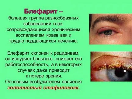 Мехлем тетрациклин око на инструкциите за употреба, как да се прилагат, как да намазка на ечемик, и бебето