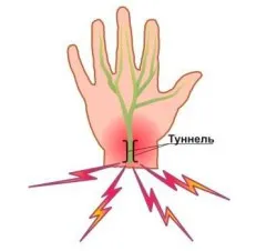 Къде е болката в лакътя и как да го (Диагностика физикален преглед) лекува Къде е болката в лакътя и как да го излекува