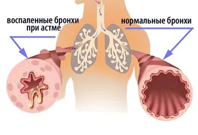 Дексаметазон предозиране симптоми, последствия, лечение