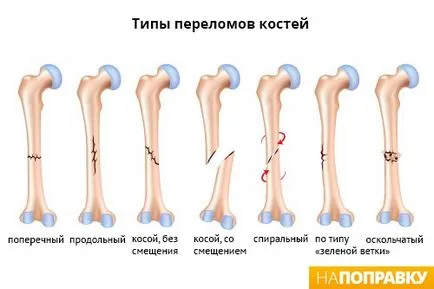 симптоми счупен крак и лечение - napopravku (преглед счупен крак) симптоми счупен крак и лечение - napopravku