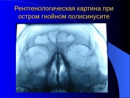 Polisinusit симптоми и лечение на всички форми на заболяването, nasmorku мрежа