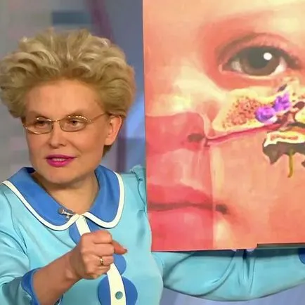 Polisinusit какво е, симптоми и лечение