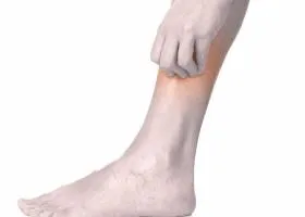 Sudamen при възрастни и деца причини, видове, лечение (възрастни) Sudamen при възрастни и деца причини, видове, лечение