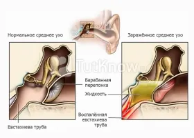 Sudamen при възрастни и деца причини, видове, лечение (деца) Sudamen при възрастни и деца причини, видове, лечение