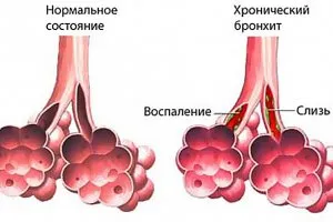 Препарати за лечение на хроничен бронхит при възрастни