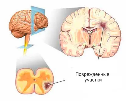 Препарати за множествена склероза, митоксантрон, solumedrol, витамини, хапчета и т.н.