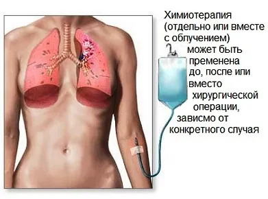 Рак на белия дроб симптоми, основните методи за диагностика, лечение, профилактика и прогноза